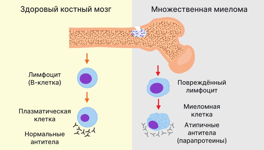 Плаплазматическая клетка микломная болезнь. Миеломная болезнь плазматические клетки. Подготовка миеломных клеток. Парапротеины в крови.