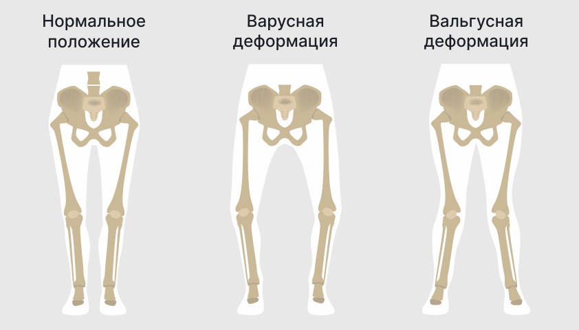 Варусная деформация коленных суставов у взрослых. Гонартроз варусная деформация\. Варусная деформация коленных суставов причины. Варусная деформация коленных суставов рентген. Варусная деформация коленных суставов рентген степени.