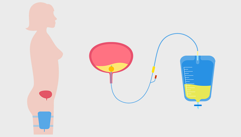 Urinary Catheter. Нефростомия показания. Мочевой пузырь иконка.