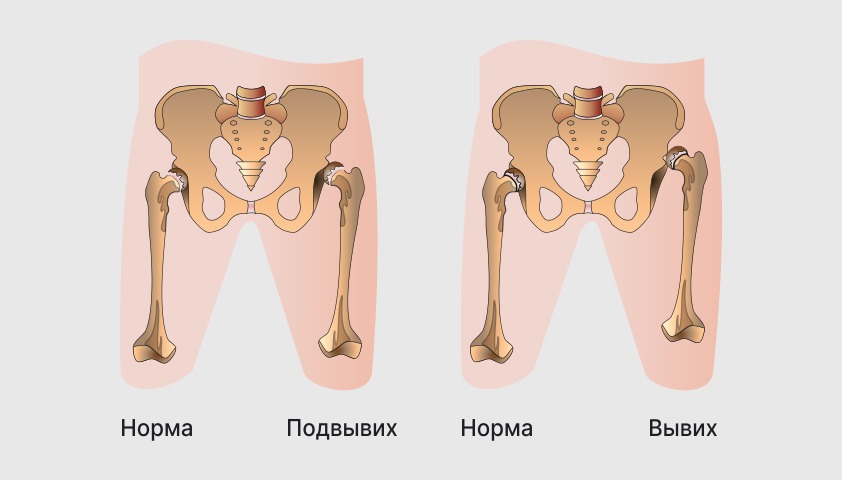 Классификация дисплазии