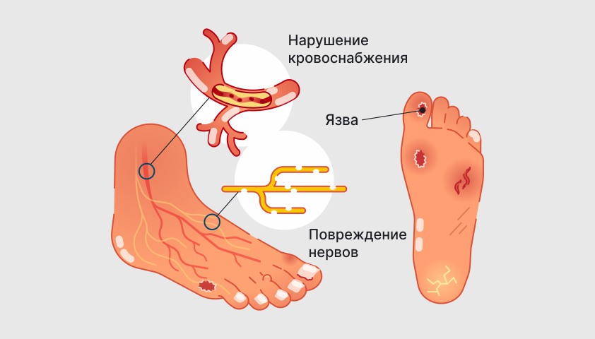 Диабетическая ангиопатия симптомы. Ангиопатия сосудов ног при диабете. Уход за диабетической стопой памятка.