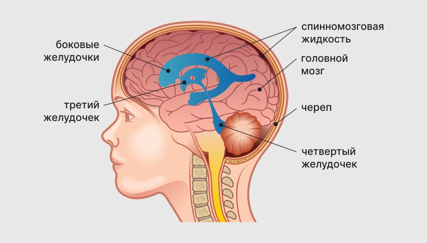 Причины гидроцефалии головного мозга. Гидроцефалия напряжение родничка.