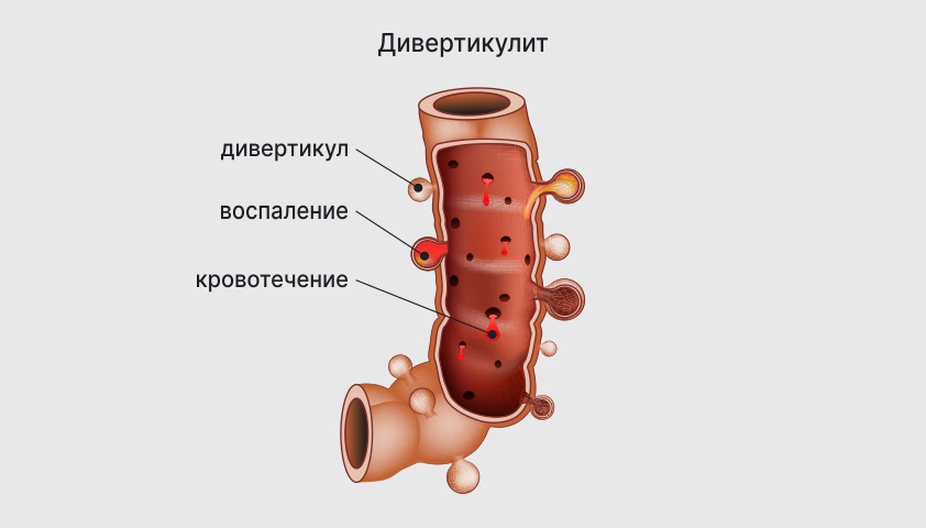 Дивертикулярная болезнь. Дивертикулярная болезнь и дивертикулит. Дивертикулит кишечника.