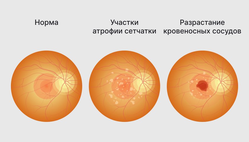 Лечение макулодистрофии