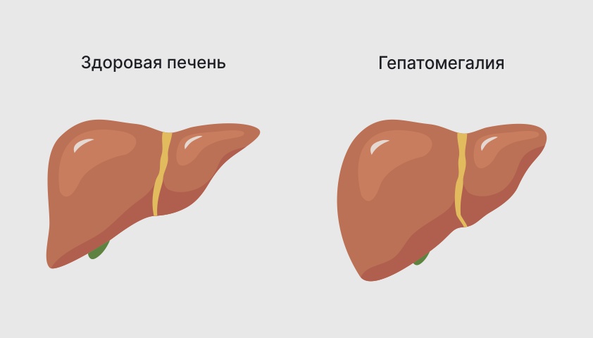 Гепатомегалия что это как лечат