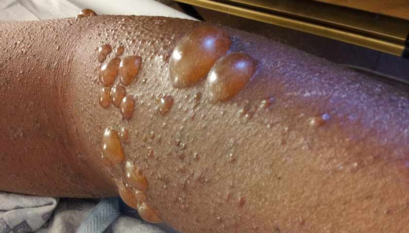 Буллёзный пемфигоид