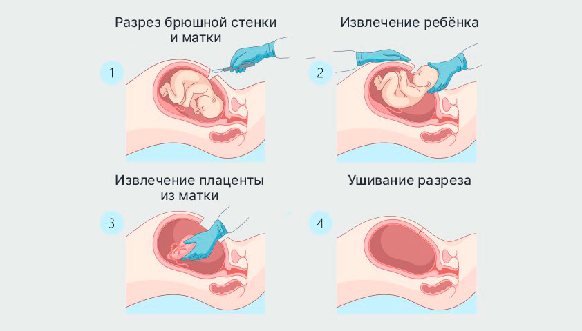 Этапы кесарева сечения