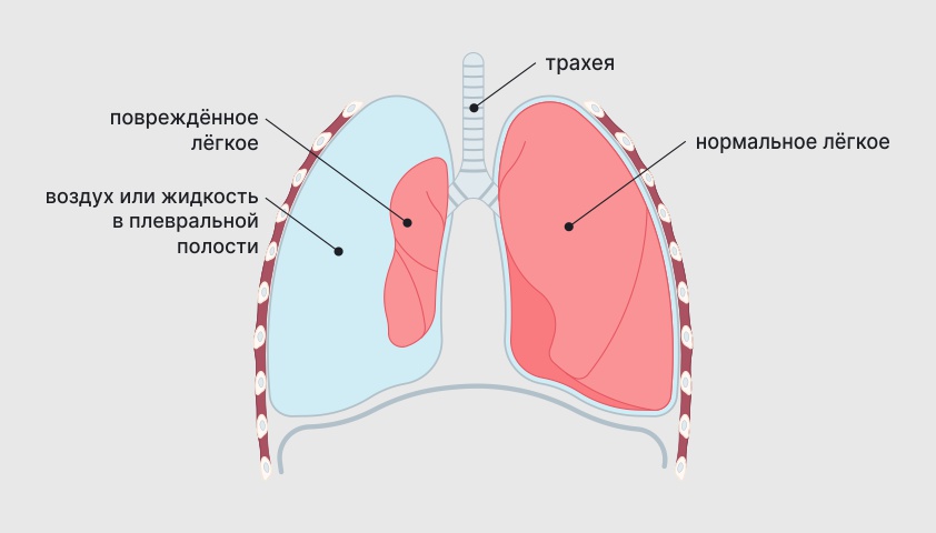 Пневмоторакс