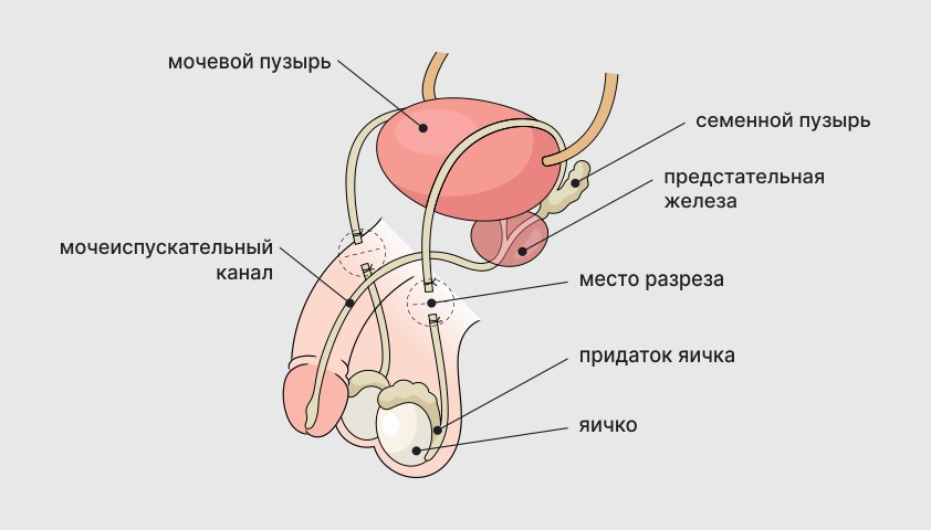 Вазэктомия