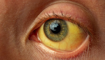 Пожелтение белков глаз — симптом синдрома Жильбера 