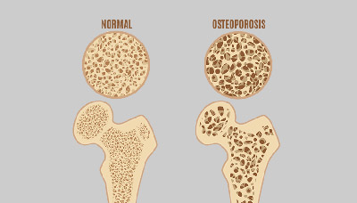 При остеопорозе изменяется структура костей