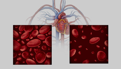 При железодефицитной анемии в крови уменьшается количество эритроцитов — красных кровяных телец