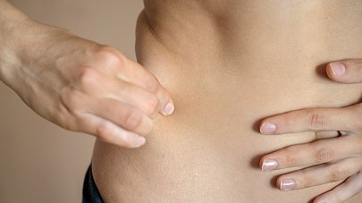 Липодистрофия