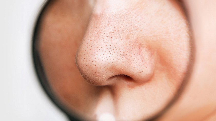 Фурункул носа - причины, симптомы, диагностика и лечение