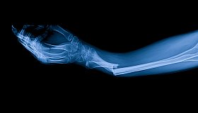 Дефицит фосфора