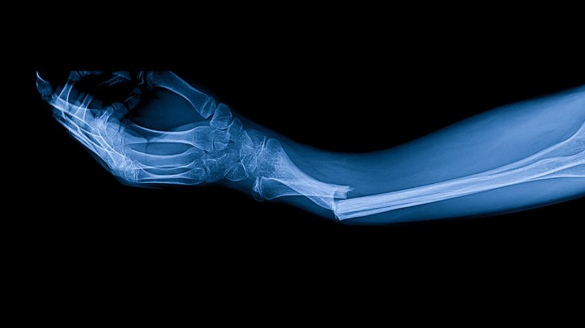 Дефицит фосфора