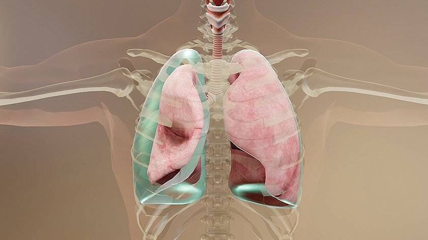 Пневмоторакс