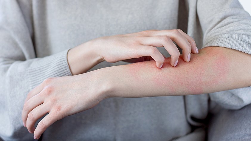 Аллергические поражения кожи