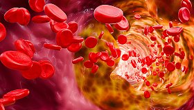 Дислипидемия