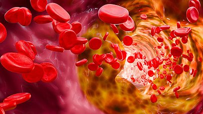 Дислипидемия