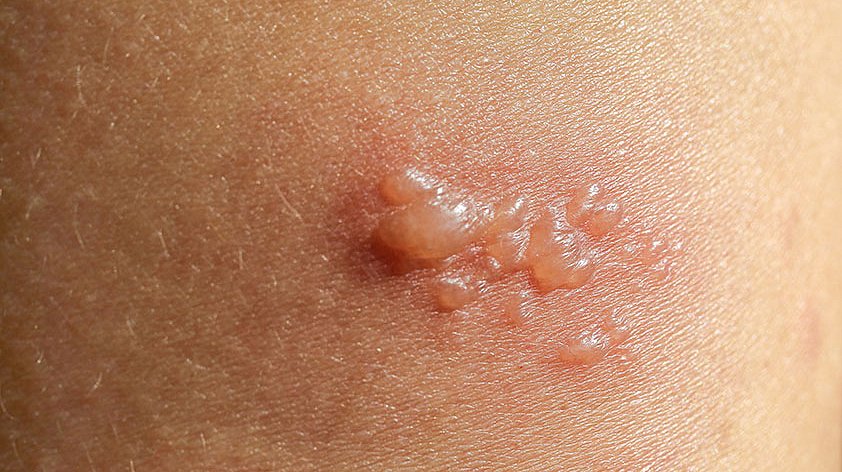 Буллёзный пемфигоид