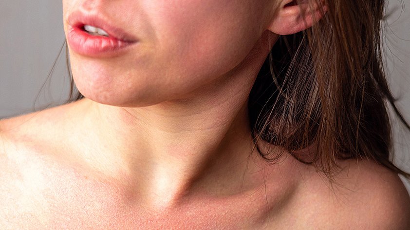 Аллергия на алкоголь