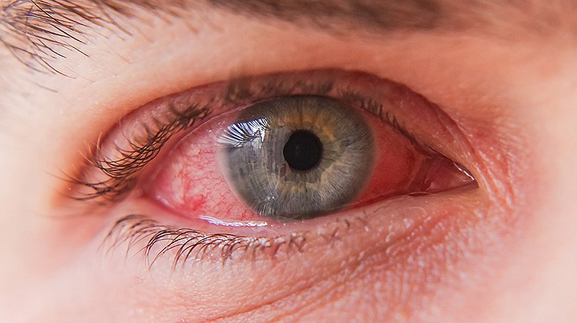Аллергические реакции на глазах | Théa