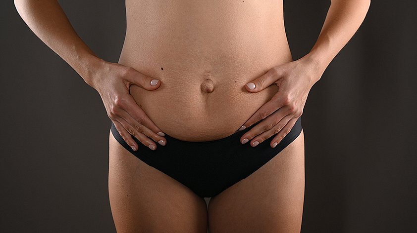 Как избавиться от обвисшей кожи на животе после родов без операции?