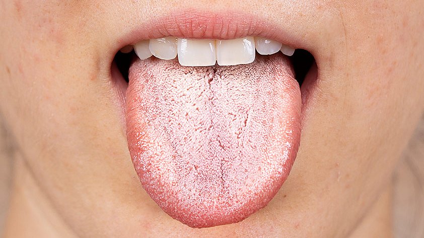 Какие болезни печени можно определить по состоянию языка