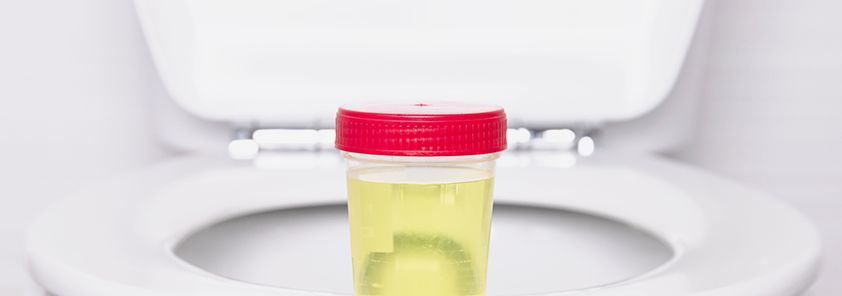 Как правильно сдавать мочу для анализа