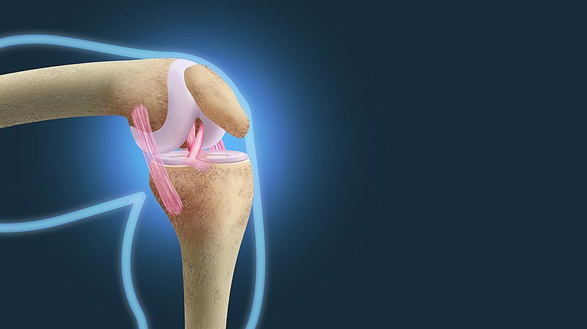 Разрыв мениска