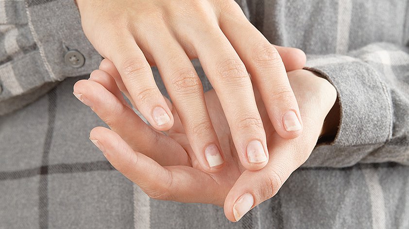 Онихолизис