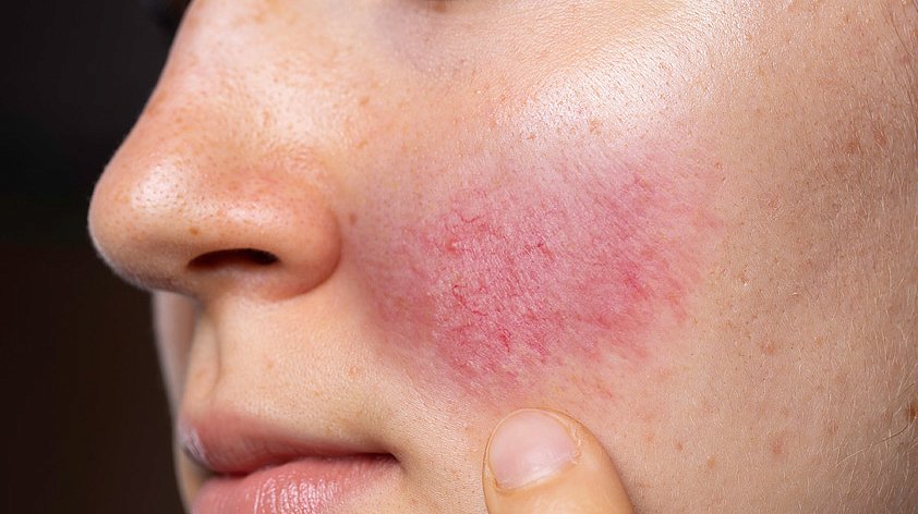 Шелушится кожа на лице: причины, профилактика и способы лечения - FitoMarket