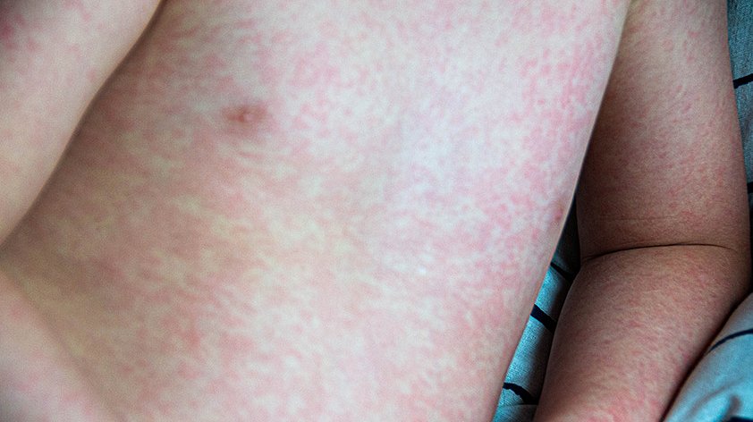 Розеола у детей