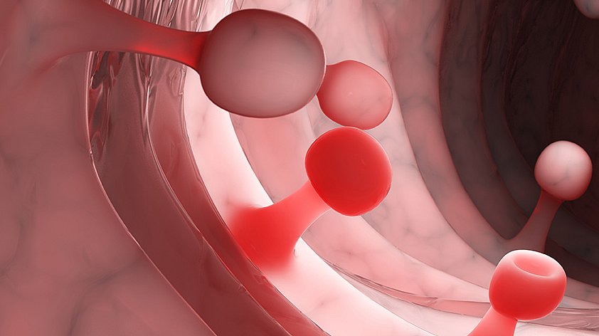 Полип эндометрия в матке