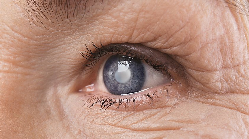 Глаукома - что это, симптомы, признаки и лечение