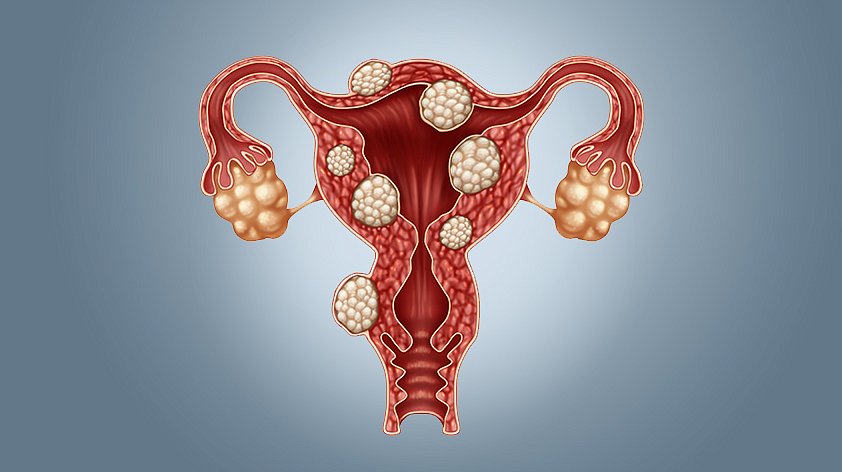 Доброкачественные и злокачественные опухоли женских половых органов