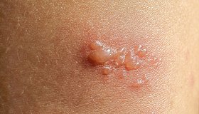 Буллёзный пемфигоид