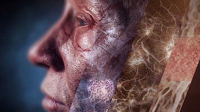 Проказа (Лепра)