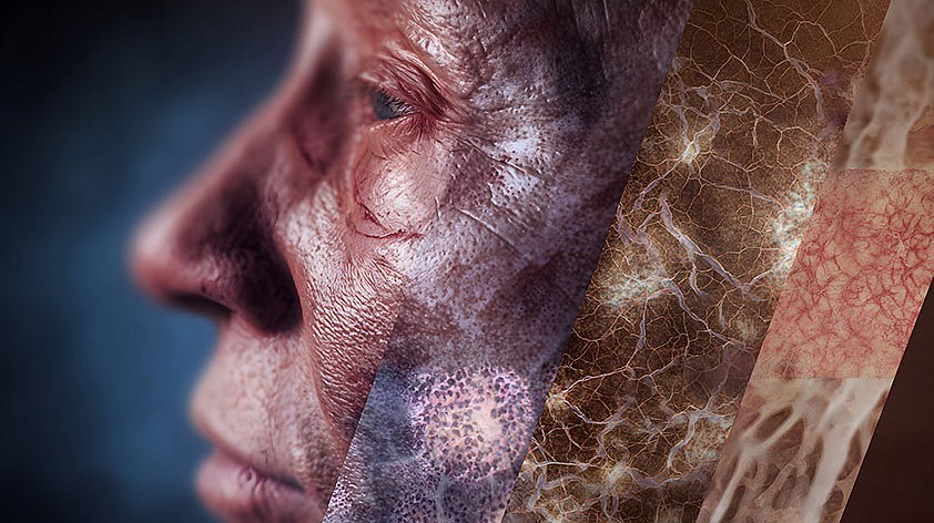 Проказа (Лепра)