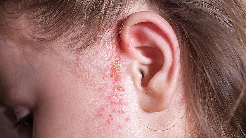 Стрептодермия