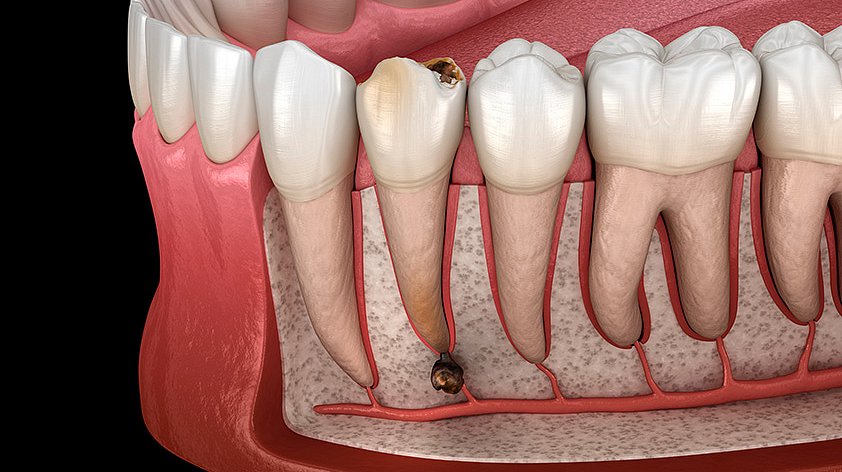 Киста зуба: по каким симптомам распознать и как лечить