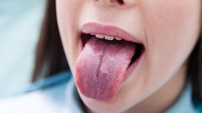 Глоссит (пятна на языке) - причины, симптомы и лечение