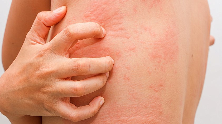 Сыпь на теле | причины, симптомы, виды высыпаний на коже, лечение