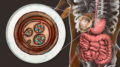 Эхинококкоз