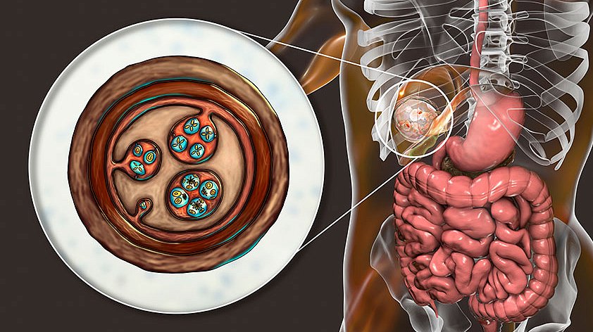 Эхинококкоз