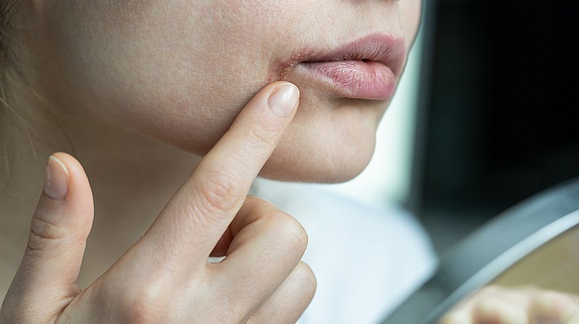 Почему появляется шелушение кожи вокруг рта? Все причины и способы лечения