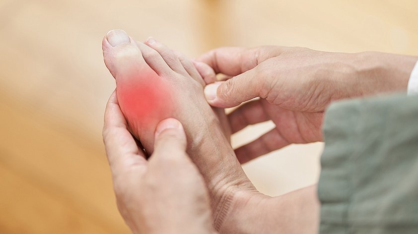 Лечение подагры