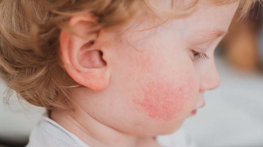Аллергия у грудного ребёнка: кто виноват и что делать? | Статьи «СМ-Клиника» для детей и подростков