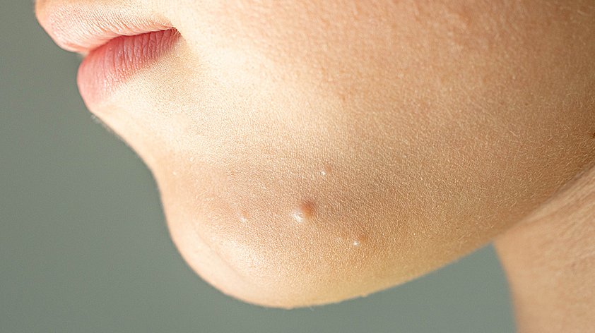 Контагиозный моллюск